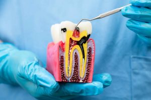 Why Patients Prefer Painless Root Canal Dubai Over Traditional Methods