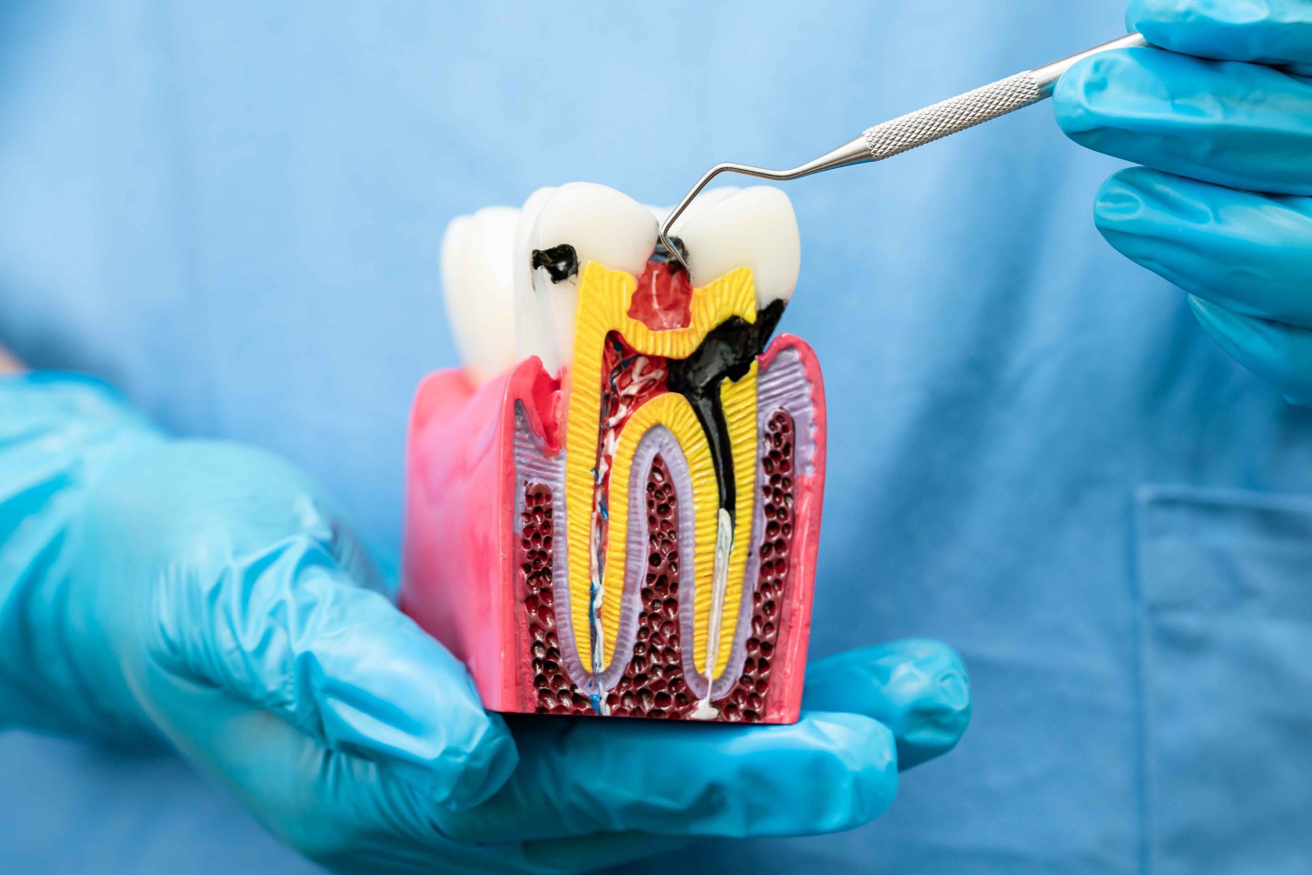 Why Patients Prefer Painless Root Canal Dubai Over Traditional Methods